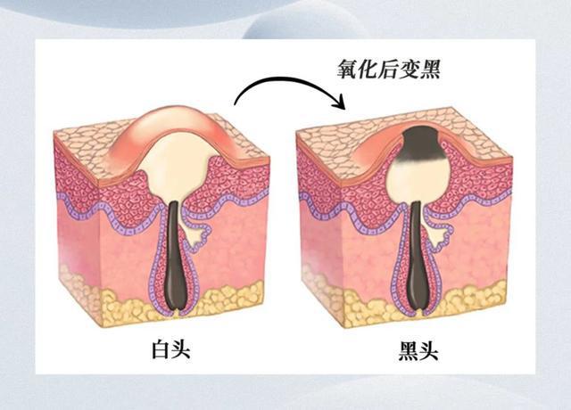 澳门一肖一码1000准确,夏日去黑头秘籍，让你告别草莓鼻